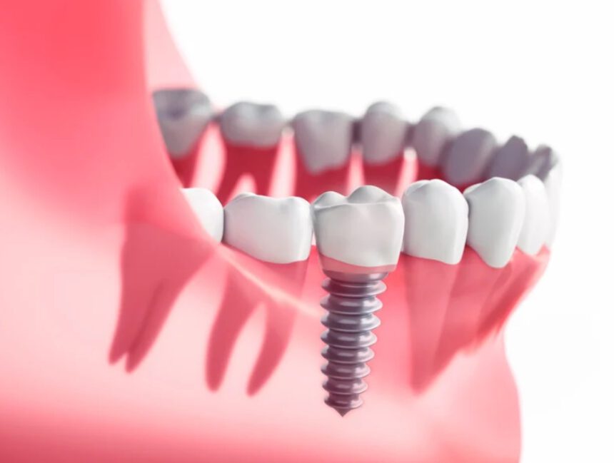Implantes Dentales vs. Dientes Fijos – Reemplazar Dientes Perdidos en Granada