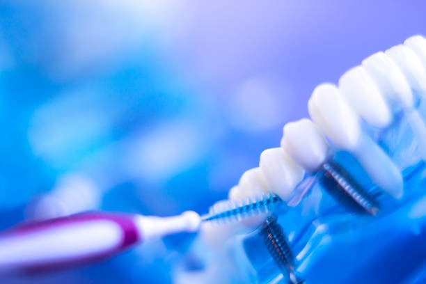 Cómo cuidar implantes dentales